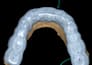 design dental splints in exocad ready for 3d printing